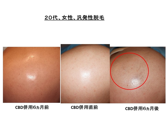 円形脱毛症　病院